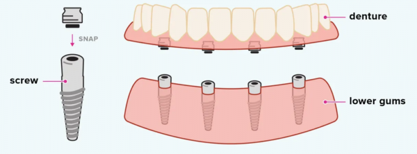 dental implants