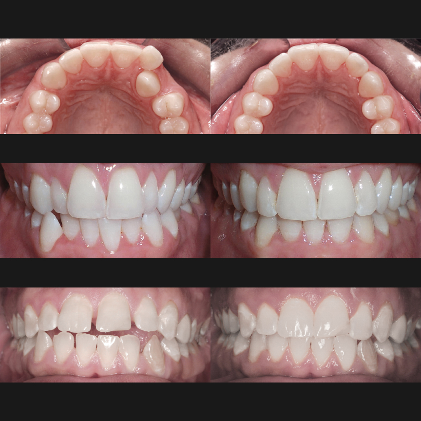 Before & After ClearCorrect Aligners